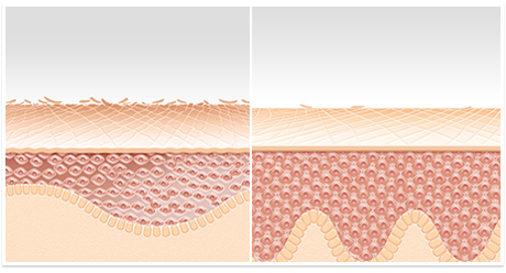 Con l'avanzare dell'età, le cellule si suddividono più lentamente e le cellule morte della pelle non si sostituiscono con la stessa velocità di prima.